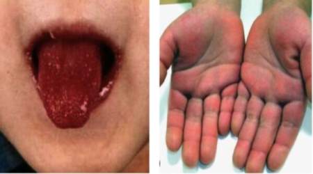 Symptoms of Kawasaki disease, including a strawberry tongue and edema in the hands