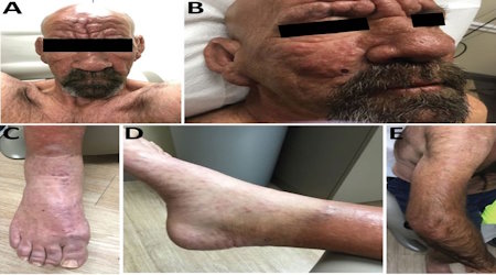 Lepromatous leprosy in a 54-year-old man in central Florida